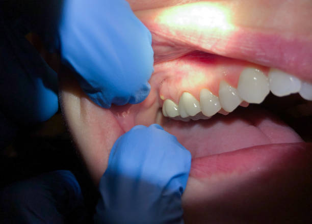 Best Knocked-Out Tooth (Avulsed Tooth) Treatment in Boulder City, NV